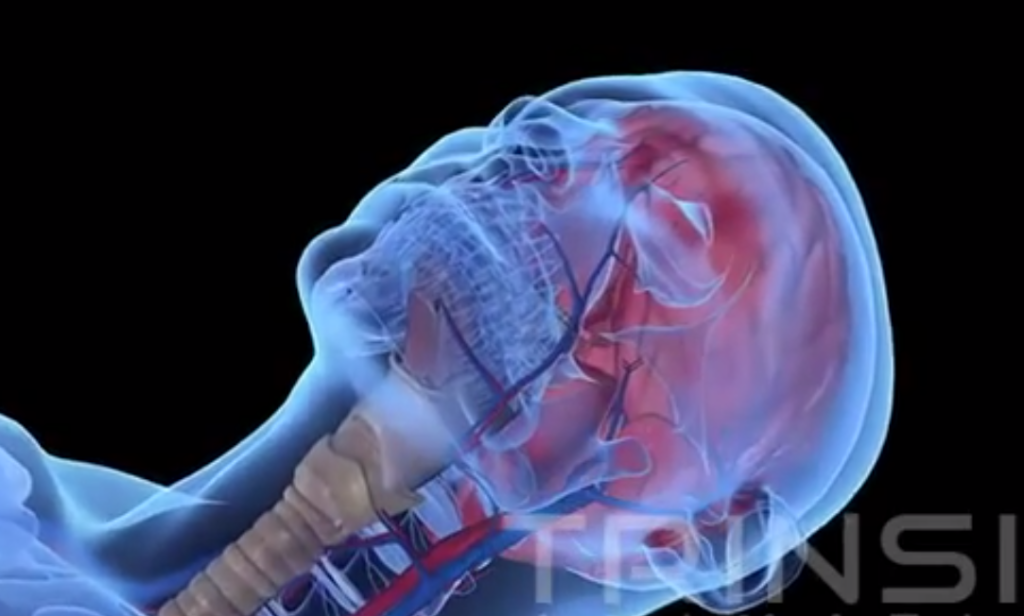 Liquid Ventilation Medical Animation | iQGlobal Studios